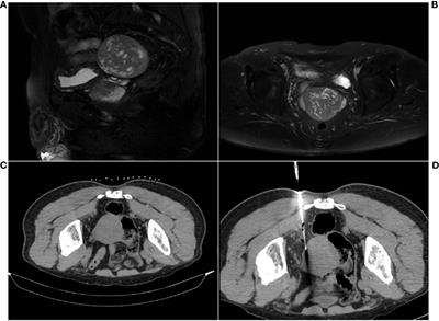 Gastrointestinal stromal tumor with small cell carcinoma infiltration: a case report